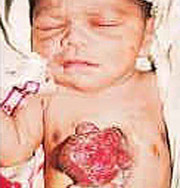 В Индии родилась девочка с оголенным сердцем