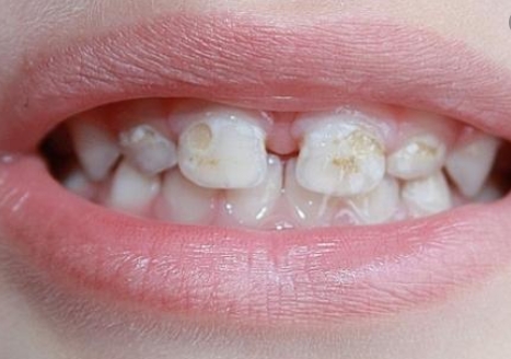 Антибиотики разрушают зубы, — утверждают ученые