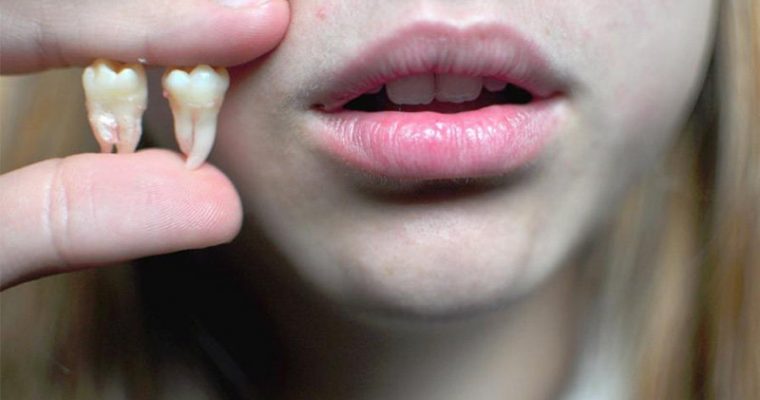 Удаление зубов мудрости: где лучше проводить процедуру