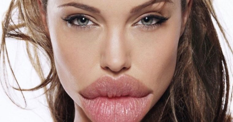 Неудачное увеличение губ — что теперь делать?