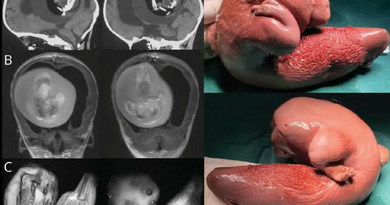 Из мозга годовалой девочки удалили… плод ее близнеца