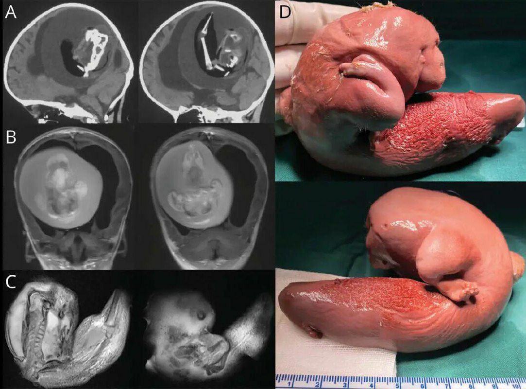 Из мозга годовалой девочки удалили… плод ее близнеца