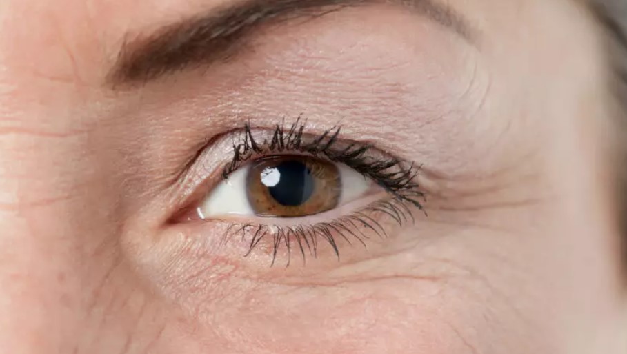 Зморшки навколо очей: причини появи та шляхи вирішення проблеми