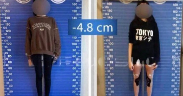 Турецкие женщины укорачивают себе ноги ради замужества