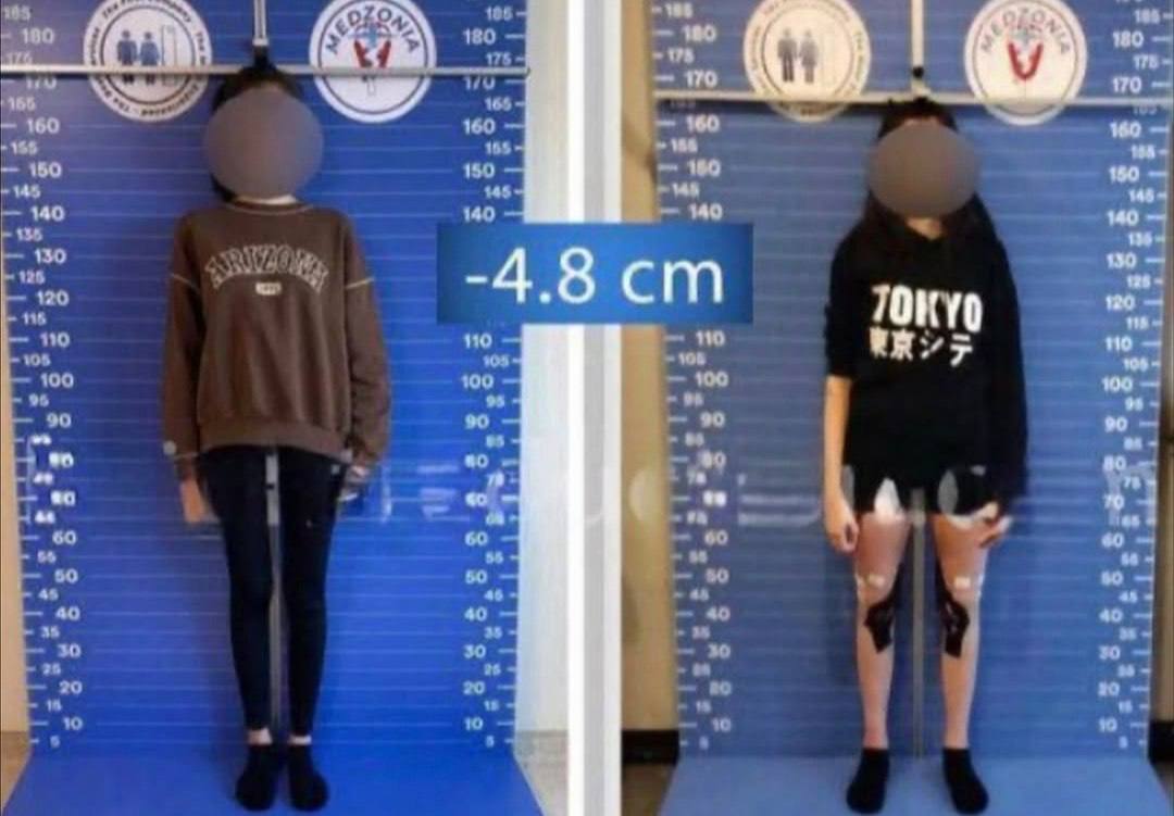 Турецкие женщины укорачивают себе ноги ради замужества