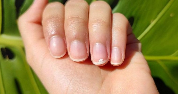 Белые полосочки на ногтях: что это значит и нужно ли лечить